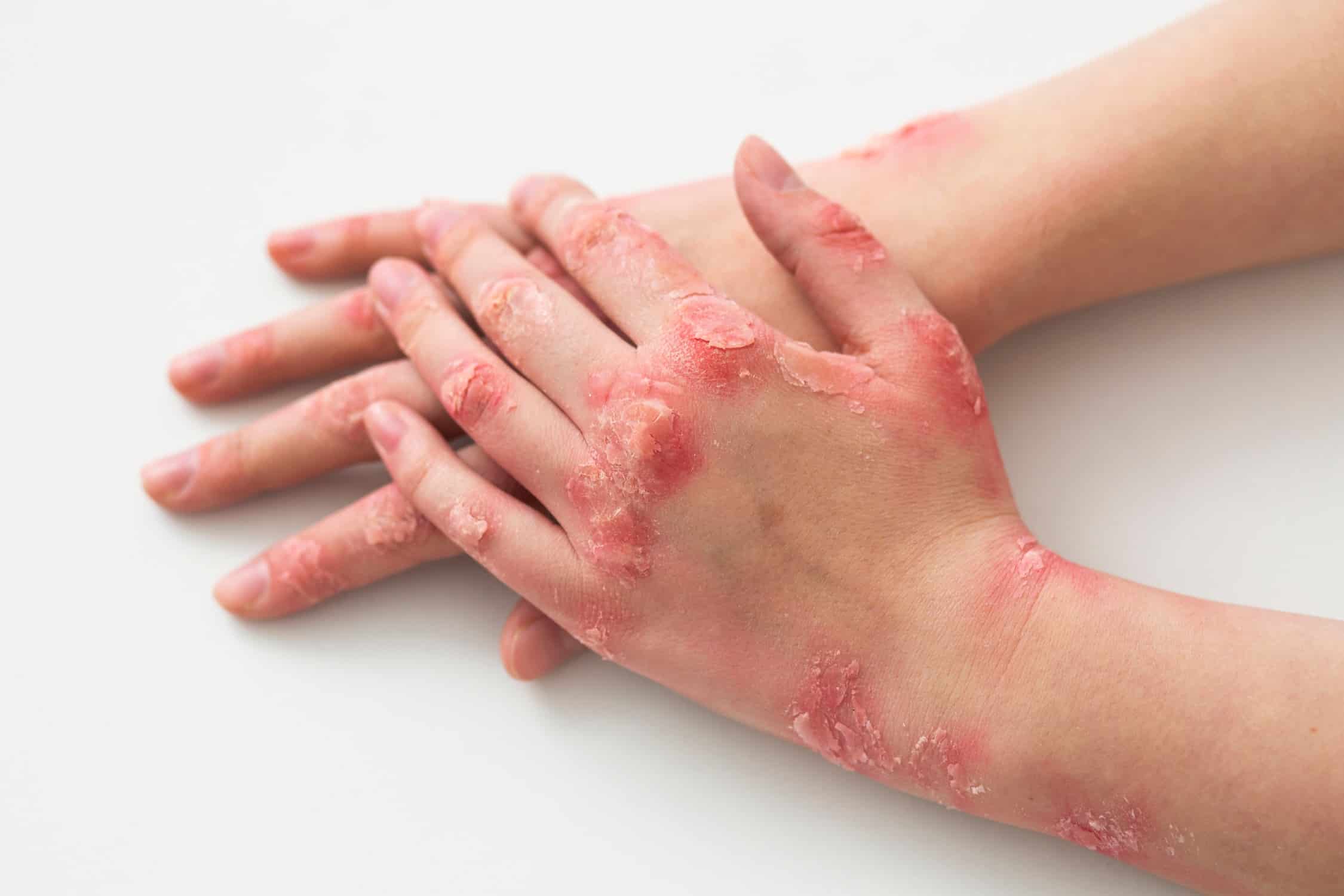 Inflammatory-Skin
